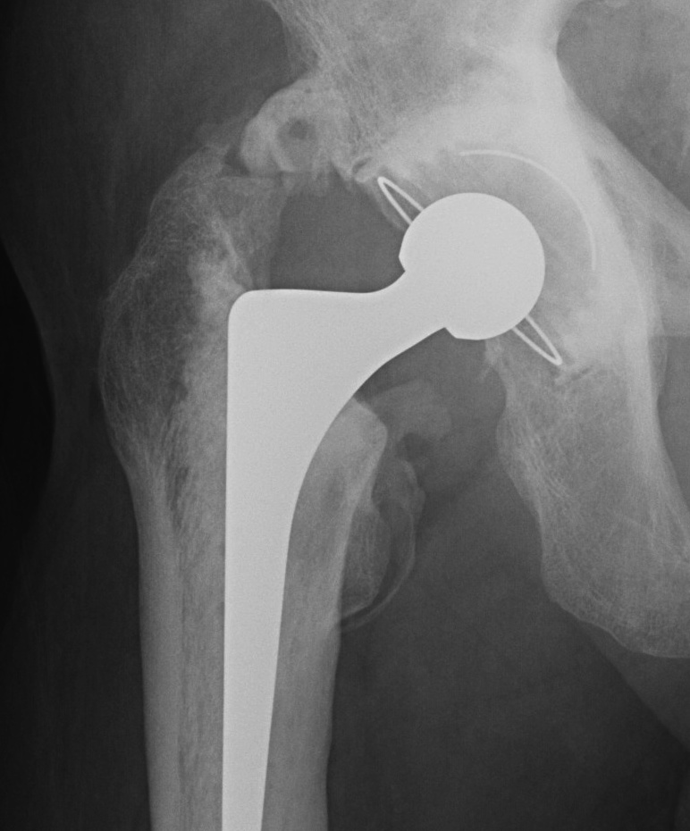 THR Hetertropic Ossification